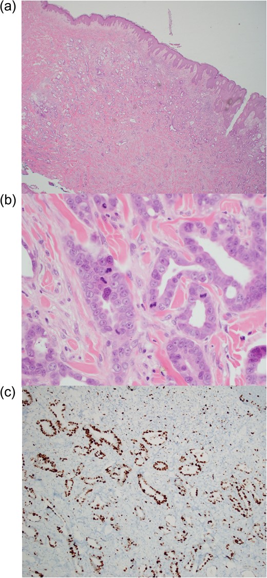 Biopsy sample demonstrating (a) dermal proliferation of infiltrating malignant glands (haematoxylin and eosin stain, ×20 magnification), (b) marked nuclear atypic and mitotic activity (haematoxylin and eosin stain, ×400 magnification) and (c) pancytokeratin stain of adenocarcinoma (×40 magnification).