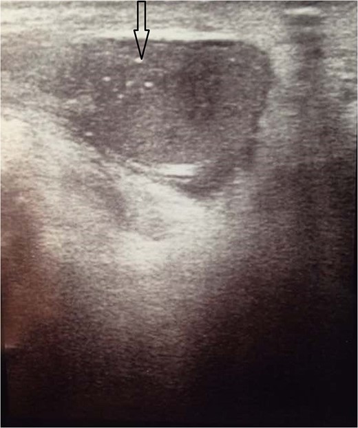 Ultrasound of the testicles showed very small atrophic left testis measuring about 2.8 × 1.7 cm2 with multiple calcifications within it (black arrow).