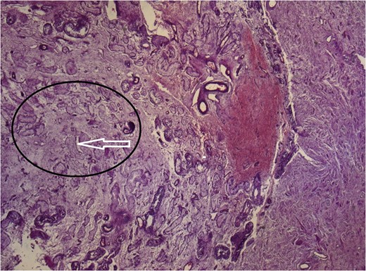 Atrophic testicular parenchyma (black circle) with hyalinized tubules (white arrow).