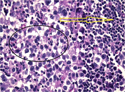 Histological examination showed nodules that contain neoplastic cell (black circle) with lymphocytic infiltration (yellow arrow).