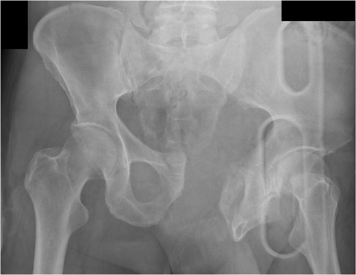 Complex pelvic fracture with wide public symphysis.