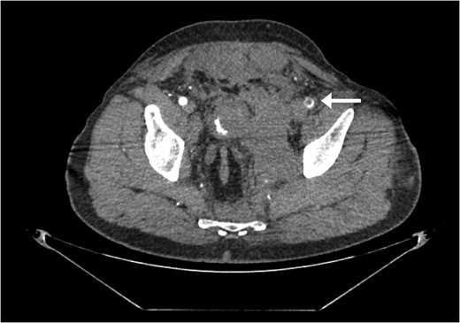 Large retroperitoneal hematoma. Arrow depicts injured left iliac artery.