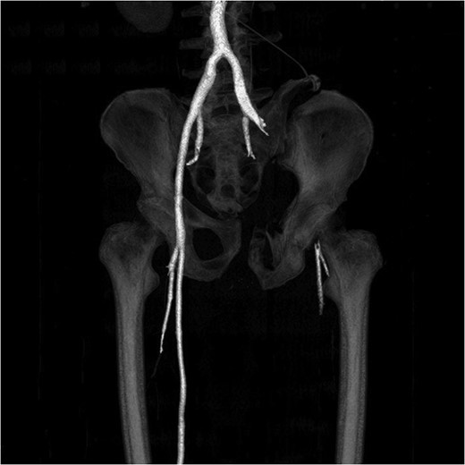 No arterial flow in left iliac artery.
