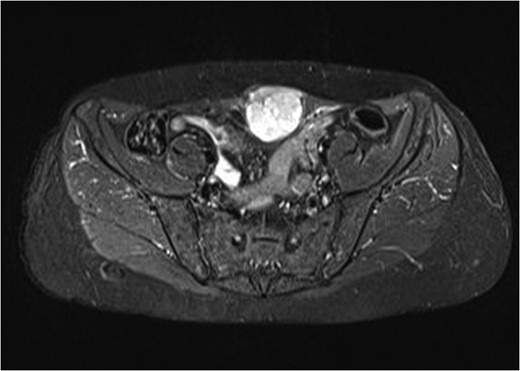 MRI imaging of the abdominal wall tumor.