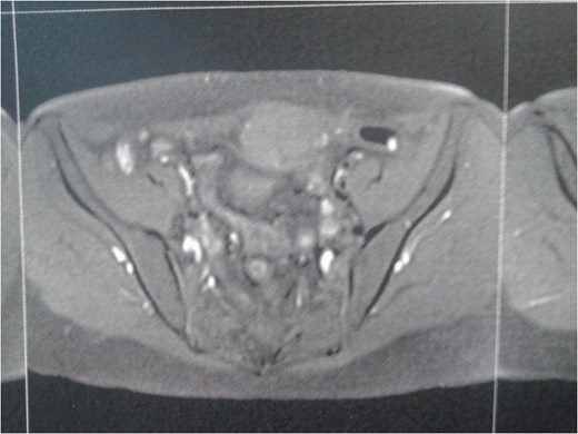MRI imaging. Absence of other disorders.