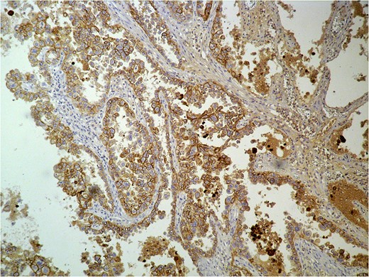 Histologic examination of the excised specimen. Positivity in cytokeratin.