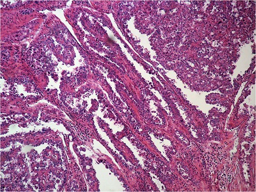 Histologic examination of the excised specimen. Positivity in cytokeratin and CA-125.
