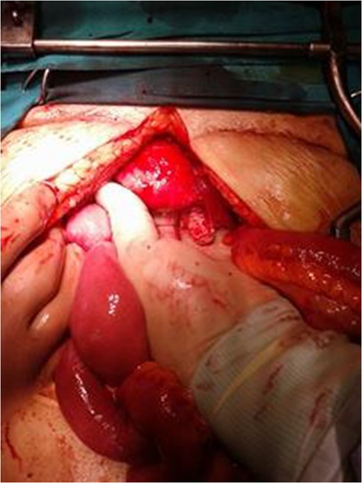 Normal condition of the right ovary intraoperatively.