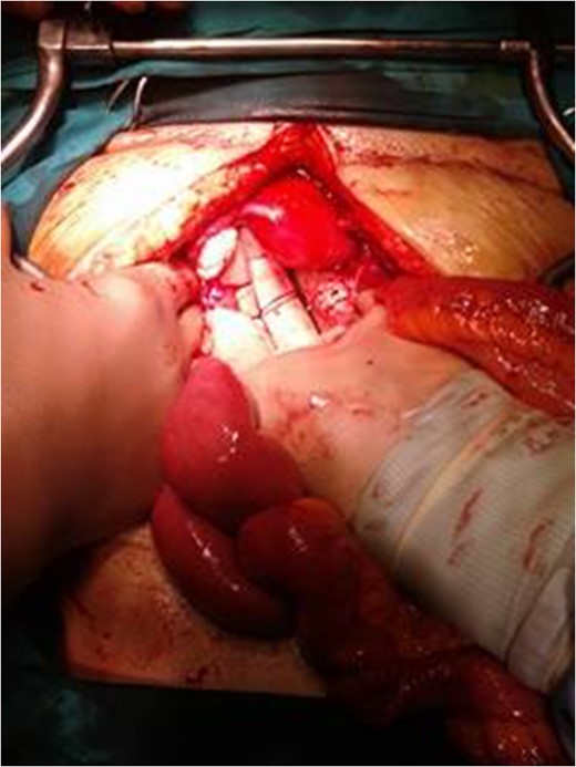 Normal condition of the left ovary intraoperatively.