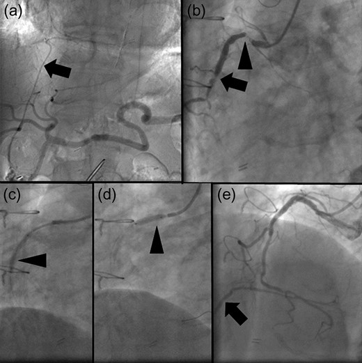 (a) Angiogram of the celiac artery showing a patent right gastroepiploic artery (RGEA) (arrow). (b) Coronary angiogram showing severe stenosis of the native right coronary artery (RCA). The proximal and middle portions of the RGEA exhibit 99% (arrowhead) and 90% (arrow) stenosis. (c, d) Two bare-metal stents (BMS) are implanted in the native RCA (arrowheads). (e) When the RCA is revascularized using the BMS, the restricted blood flow improved. Moreover, the retrograde flow of contrast medium to the patent RGEA is observed (arrow).