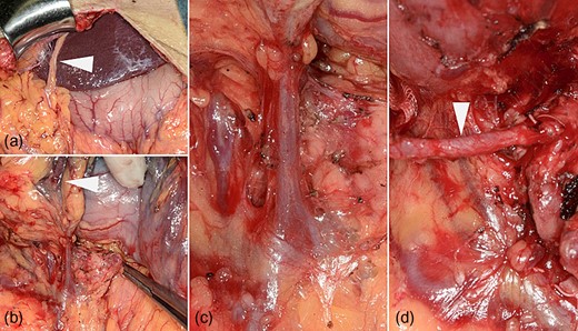 (a) The right gastroepiploic artery (RGEA) at the start of the surgery (arrowhead). (b) Lymph flow from the gastric angle is observed in the infrapyloric lymph ducts using indigo carmine dye (arrowheads). (c) The translucent, whitish autonomic nerves that twine around the surface of the pancreas and the anterior superior pancreaticoduodenal vein can be observed during dissection along the outermost layer of nerves. (d) The RGEA is preserved after infrapyloric lymphadenectomy (arrow).