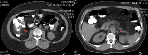 Axial tomographic view with oral contrast. The red arrow shows the tumor in the right colon and the arrowhead pointing synchronous contralateral adrenal metastasis.