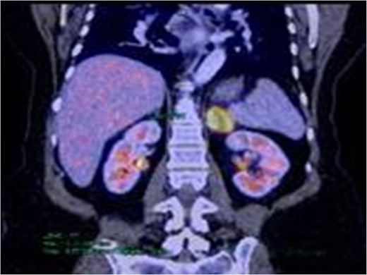 PET–CT frontal view. Increased uptake and metabolism (SUV 13.1) to left adrenal level is observed.