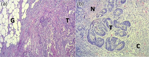(a) Histological section of right colon with hematoxylin and eosin technique in ×400 field. It states: Tumor (T) and pericolonic fat (G). (b) Histological section of left adrenal gland with hematoxylin and eosin technique in ×400 field. Upper left to lower right are indicated: necrosis (N), tumor (T) and adrenal cortex (C).