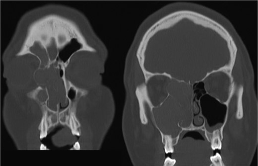 Coronal CT image indicating extent of soft tissue in the right nasal passage, malformation of the right lamina papyracea, and complete opacification of the right maxillary, ethmoidal and frontal sinus.