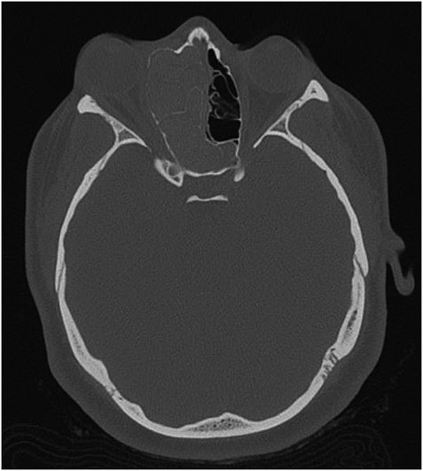 Axial CT image indicating widening of the ostiomeatal complex with malformation of the right ethmoid.