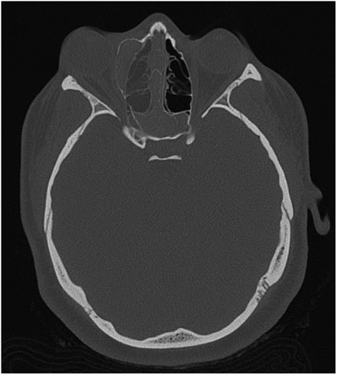 Axial CT view of the ethmoid labyrinth with the left side super imposed on the right side over the midline for comparison.