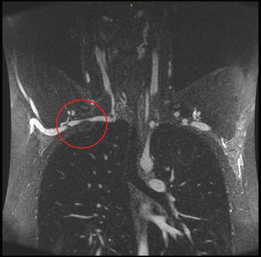 MRA chest showing compression of the subclavian artery.