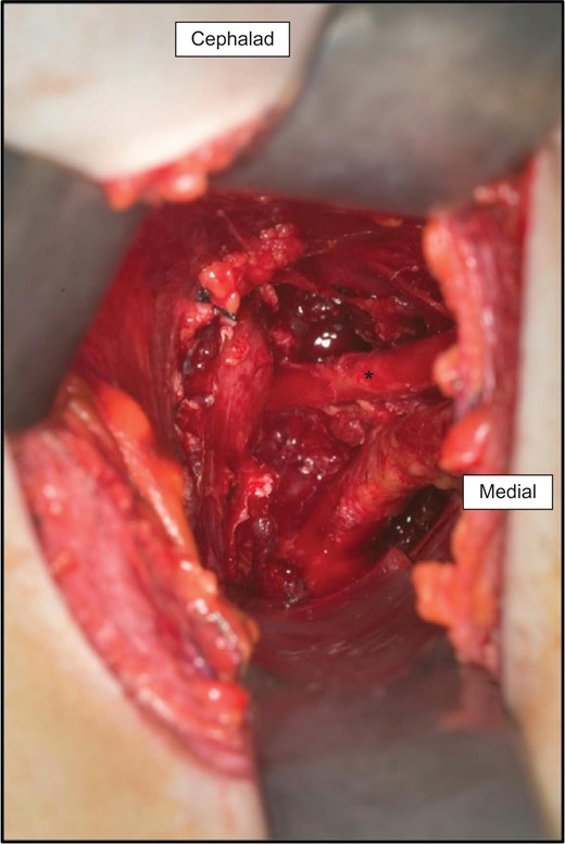 Transaxillary exposure of the right thoracic outlet.