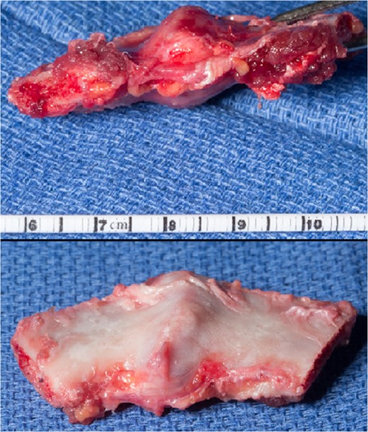 Right first rib with hypertrophic callus.