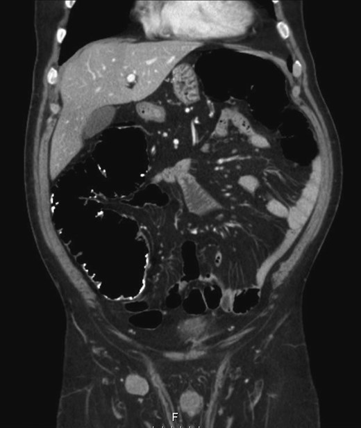 Right inguinal lymphadenopathy in colonography by computerized tomography.