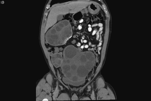 Coronal CT showing the hydatid cysts with daughter cysts within the larger structures.