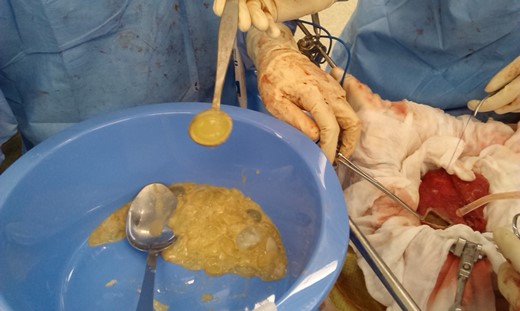 Intraoperative photograph showing the cystotomy and contents being removed. Daughter cysts are shown in the bowl (clear, jelly like structures).