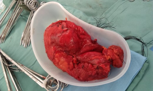 The pelvic cyst once removed minus hydatid fluid and daughter cysts.