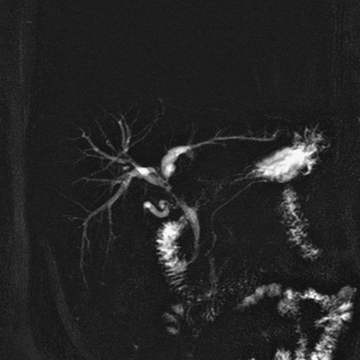 Preoperative MRI/MRCP with Bismuth Type I stricture of the common hepatic duct.