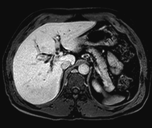 Preoperative axial T1 MRI with dilated right and left intrahepatic bile ducts.