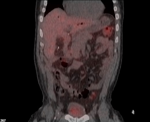 Postoperative In-111 octreotide scan showing no evidence of persistent or recurrent disease following biliary resection and hepaticojejunostomy reconstruction.