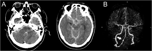 (A) Computed tomography images show diffuse subarachnoid hemorrhage. (B) Computed tomography angiogram shows a fusiform aneurysm at the right vertebral artery (arrow) with contralateral hypoplasia.