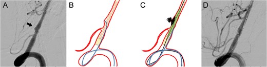 (A) Preoperative angiogram shows a dissecting aneurysm with a blister. (B) The first stent was deployed across the aneurysm and the second stent overlapped the first stent. (C) Coiling was performed under the support of a balloon catheter after the first coil perforated the blister. (D) Complete obliteration of the pseudolumen was achieved and the parent artery was preserved.