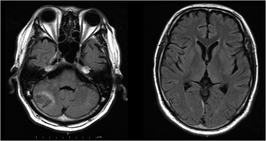 Magnetic resonance images obtained 3 weeks after the procedure shows right cerebellar infarction without damage of the brainstem.