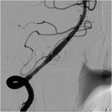 Angiogram obtained 6 months after the procedure shows no recurrence of vertebral artery dissection.