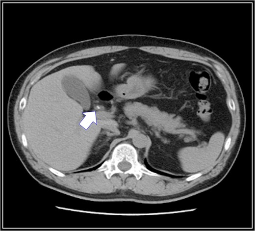 Preoperative abdominal computed tomography scan. There are stones in his cystic duct (white arrow).