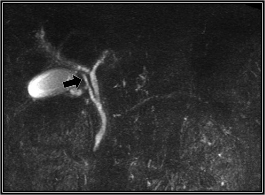 Preoperative magnetic resonance cholangiopancreatography scan. The right accessory hepatic duct branching from the cystic duct (black arrow) dominates an anterior segment of the right hepatic lobe.