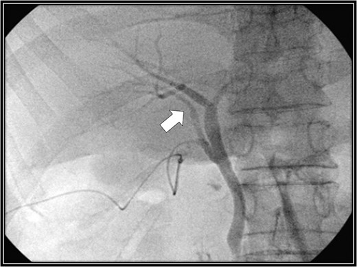 Intraoperative cholangiography image. The right accessory hepatic duct branching from the cystic duct (white arrow) dominates an anterior segment of the right hepatic lobe.
