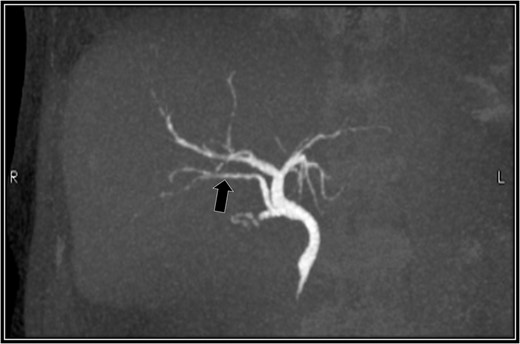 Drip-infusion cholangiography-computed tomography scan. Forty-eight days postoperatively, the right accessory hepatic duct is intact (black arrow), and it dominates an anterior segment of the right hepatic lobe, as indicated by the intraoperative cholangiography scan.