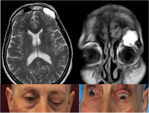 Pre-operative T2-weighted MRi showing a frontal sinus mucocele with intraorbital and intracranial extension, causing ptosis, exophtalmus and diplopia.