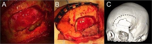 (A) left frontal craniotomy and aspiration of the mucocele, demonstrating a wide communication between the intracranial and the sinusal spaces; (B) the surgical cavity, emptied of the mucocele, has been filled with abdominal fat and closed with pericranium and dural patch; and (C) 3D rendering of the approach.