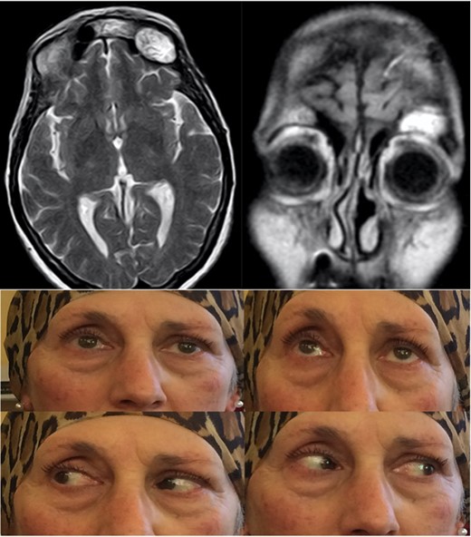 Post-operative T2-weighted MRi showing the fat tissue filling the surgical cavity, with improvement of the ptosis and absence of diplopia.