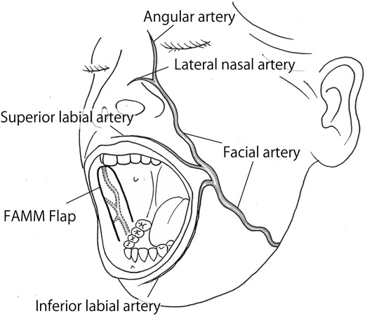 Design of the FAMM flap.