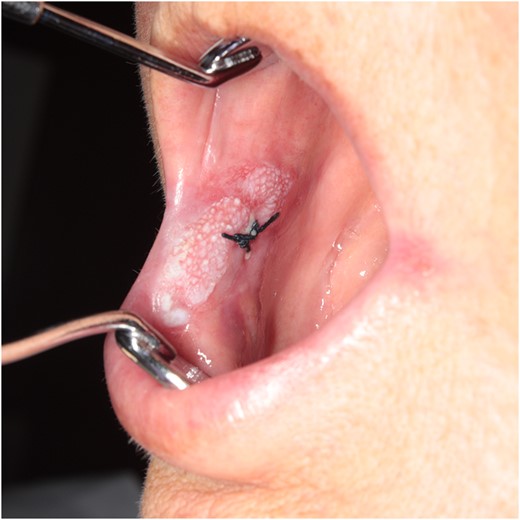 Intraoral photograph of the initial examination. A rough-surfaced tumor measuring 25 × 10 mm2 is visible over the region from the mucosal surface of the right labial commissure to the lower lip (vermilion border). Black sutures were used following a biopsy conducted at the previous hospital.