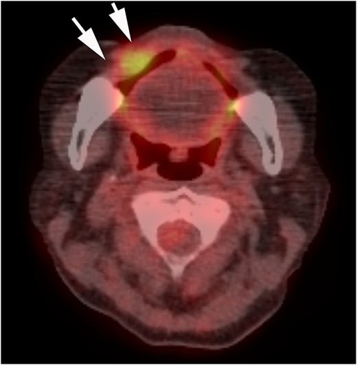 PET-CT findings. Invasion localized to the right buccal mucosa is visible (arrow).