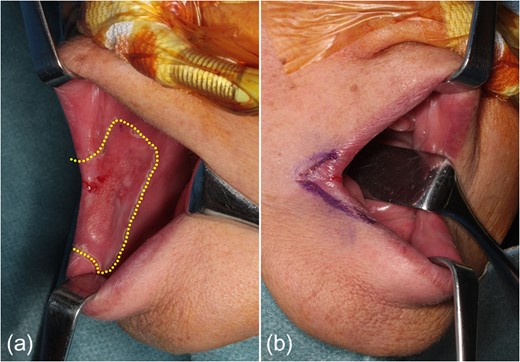 Resection range. (a) The resection measures 40 × 30 mm2 on the mucosal side. (b) The resection on the skin side includes the white upper lip with a 10-mm margin neighboring the labial commissure, and 5- and 10-mm widths of the upper and lower vermilions, respectively.