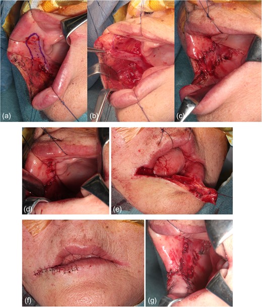 Operative findings. (a) FAMM flap design. The pedicle is close to the range of tumor resection. (b) Elevation of the FAMM flap. (c) Suture fixation of the flap in the defect of the buccal mucosa. (d) Reefing of the region from where the flap is obtained. (e) Elevation of the vermilion flap. (f) Extension of the vermilion flap followed by suture fixation in the defective area. (g) Appearance of the intraoral surface.