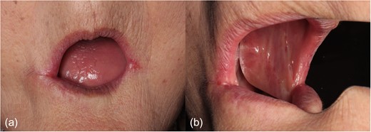 Postoperative photographs. (a) Approximately 1 year after the operation, aesthetic satisfaction is obtained. There is no restriction in mouth opening. (b) Appearance of the intraoral surface (image on the mirror).