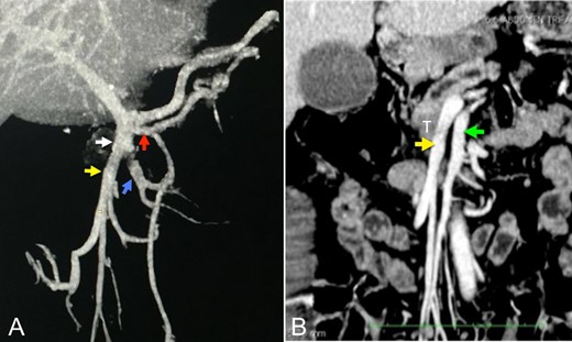 (A and B) Angiotomography showing the venous reconstructions of the portal-mesenteric axis and superior mesenteric artery in the coronal plane. White arrow: ileal trunk of the superior mesenteric vein. Red arrow: first jejunal branch (5.5 mm). Yellow arrow: venous tributary of the ileal venous ‘trunk’ involved by the tumor (9.6 mm). Blue arrow: venous tributary of the ileal trunk (9.3 mm). White arrow: ileal venous ‘trunk’. Green arrow: superior mesenteric artery (8 mm). T: tumor. It is important observing that, although the ileal venous ‘trunk’ involved by the tumor (yellow arrow) has the same diameter of the other ileal venous ‘trunks’ (blue arrow), a larger number of small tributary veins is observed in the first trunk.