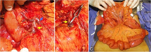 Intraoperative pictures. (A) Aspect after pancreas tumor dissection and the tributaries of the superior mesenteric vein. (B) Application of the vascular clamp in venous tributary involved by the tumor. (C) Aspect of the intravenous congestion in the small intestine mesentery after the clamping procedure (venous occlusion test). Yellow arrow: venous tributary of the ileal trunk involved by the tumor. Blue arrow: venous tributary of the ileal venous ‘trunk’ free from the tumor. T: tumor.